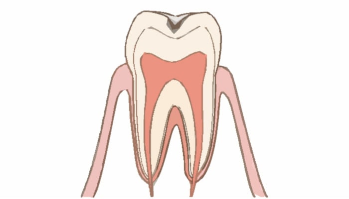 C1：エナメル質内の虫歯