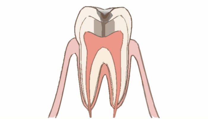 C2：象牙質に達した虫歯