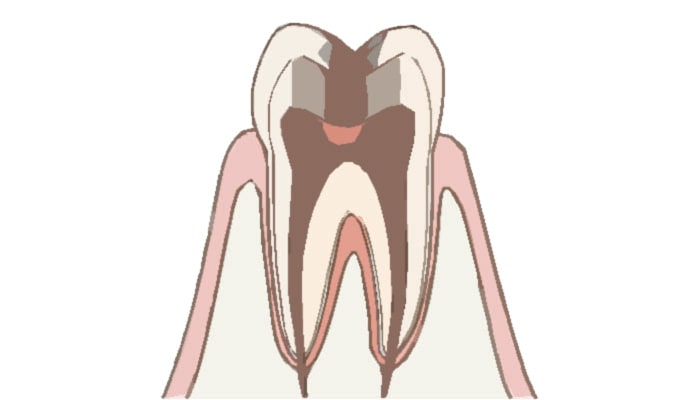 C3：歯髄(神経)に達した虫歯